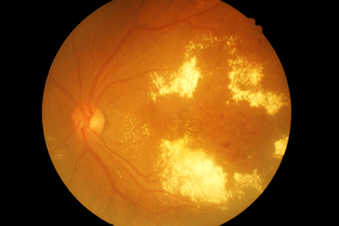 Retina scan showing diabetic retinopathy