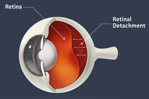 Diagram of retinal detachment