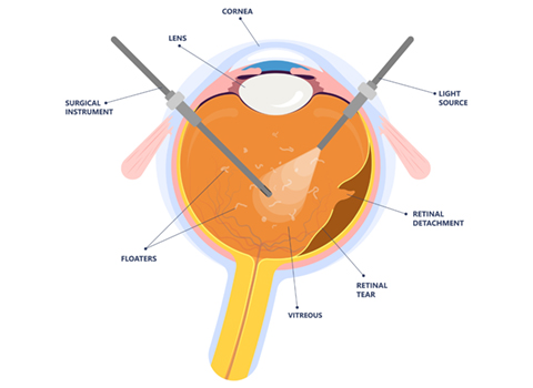 Diagram of Vitrectomy procedure for retinal detachment
