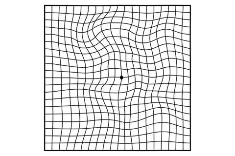 Amsler grid showing wavy vision